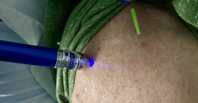 Laser Acupuncture