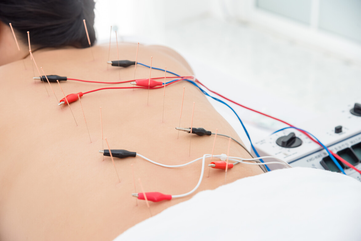 #electroacupuncture #painmanagement #paintreatment