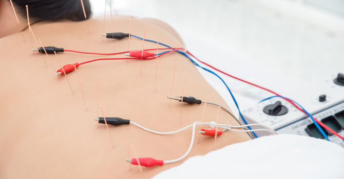 Electroacupuncture Advantages image